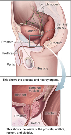 Prostatelead.jpg